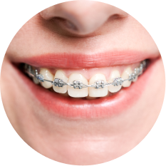 Smile brackets