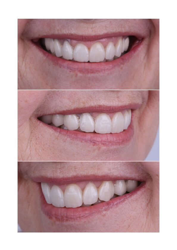 Холивудска усмивка и Smile Design в Клиника Киряков